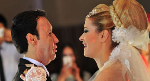 Yüz nakli olan Recep Sert ve eşi bebek bekliyor