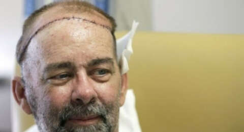 Dünyanın ilk kafatası nakli gerçekleştirildi