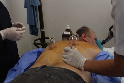 Yüksek İhtisas Eğitim ve Araştırma Hastanesinde hacamat ve mezoterapi