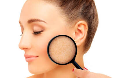 Cilt lekeleri kabusunuz olmasın