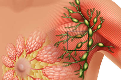 Meme kanseri çocuk sahibi olmaya engel mi?