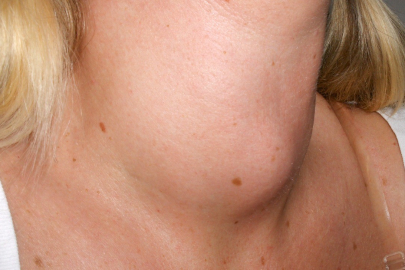 Boynunuzda şişlik varsa dikkat