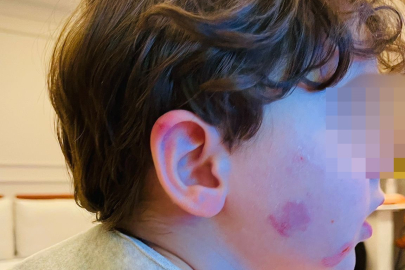 Kreşe bıraktığı çocuğunu darp edilmiş halde aldı